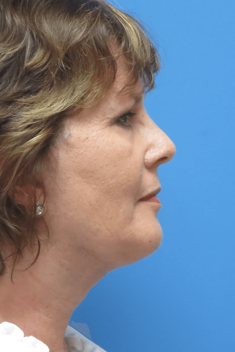 58-year-old-facelift-necklift-chin-implant-upper-and-lower-eyes-1-After 58-year-old-facelift-necklift-chin-implant-upper-and-lower-eyes-1-After