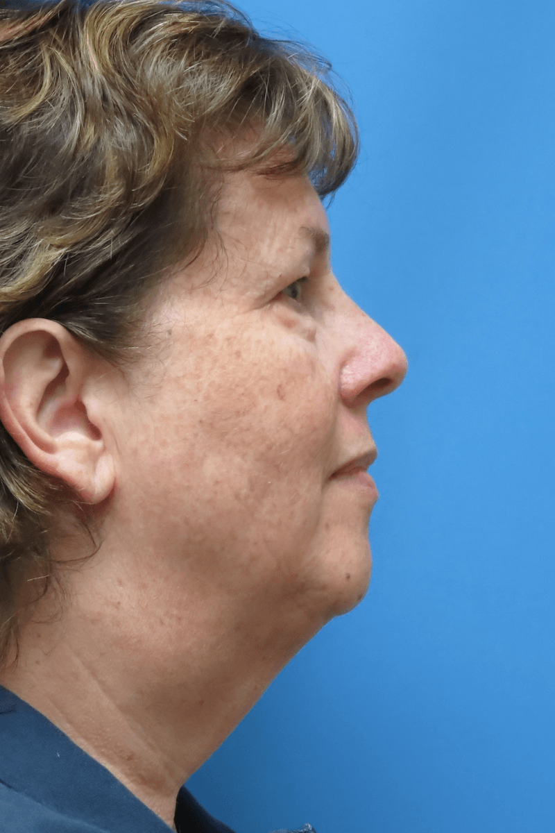 58-year-old-facelift-necklift-chin-implant-upper-and-lower-eyes-1-Before 58-year-old-facelift-necklift-chin-implant-upper-and-lower-eyes-1-Before