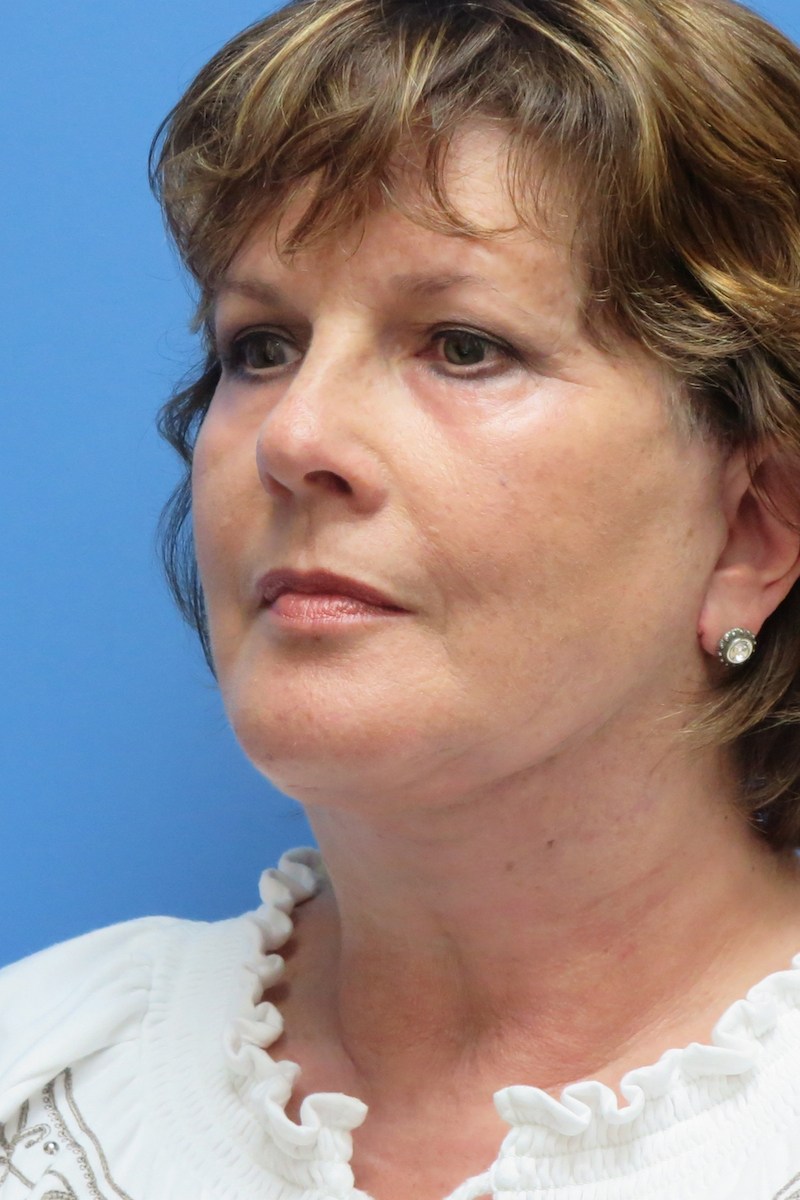 58-year-old-facelift-necklift-chin-implant-upper-and-lower-eyes-4-After 58-year-old-facelift-necklift-chin-implant-upper-and-lower-eyes-4-After