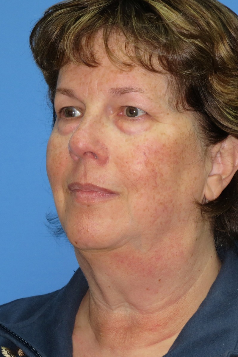 58-year-old-facelift-necklift-chin-implant-upper-and-lower-eyes-4-Before 58-year-old-facelift-necklift-chin-implant-upper-and-lower-eyes-4-Before
