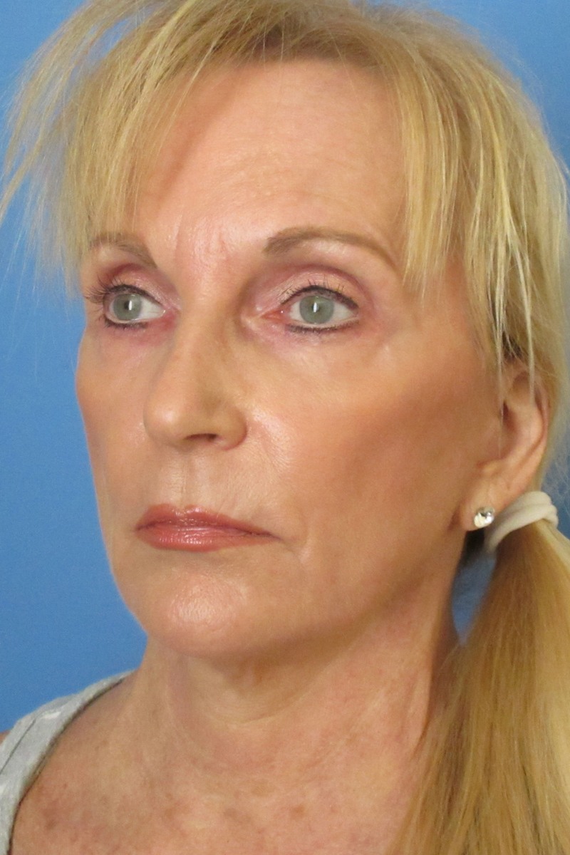 65-yr-old-facelift-and-full-face-laser-After 65-yr-old-facelift-and-full-face-laser-After
