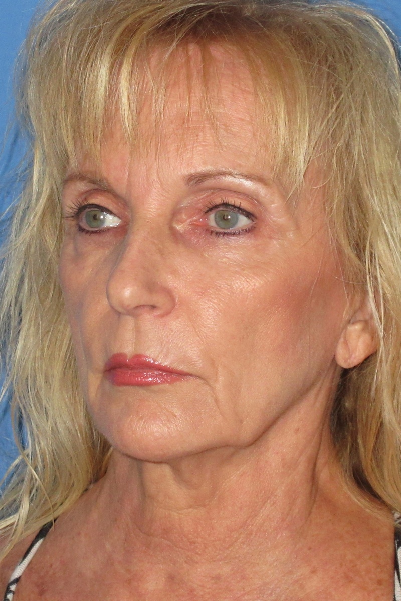 65-yr-old-facelift-and-full-face-laser-Before 65-yr-old-facelift-and-full-face-laser-Before